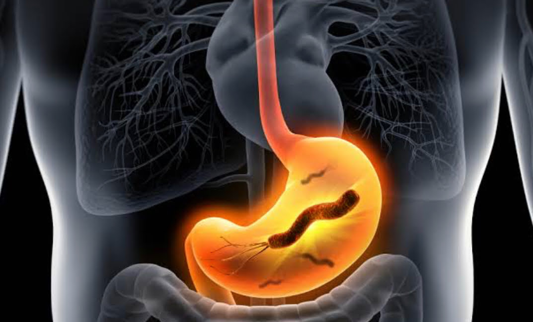 H. pylori- Causes, Diagnosis, Treatment and Prevention