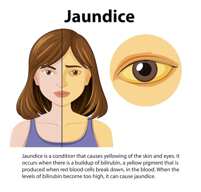 Jaundice- Causes, Symptoms, Complications and Prevention