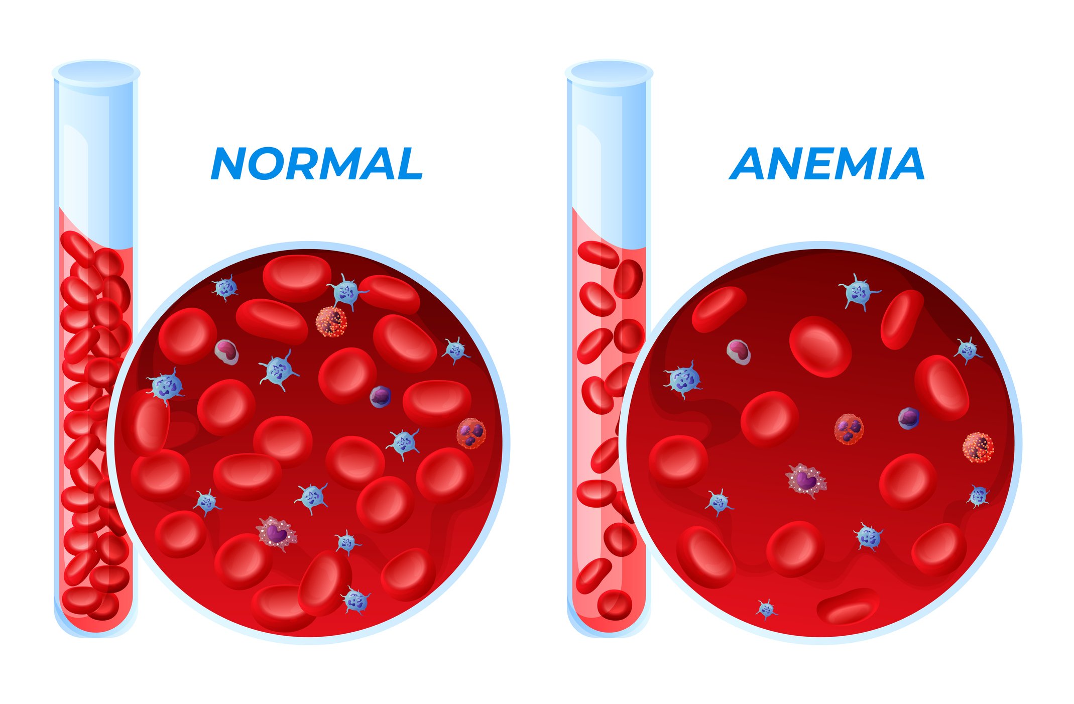 Anaemia- Causes, Diagnosis, Treatment and Prevention