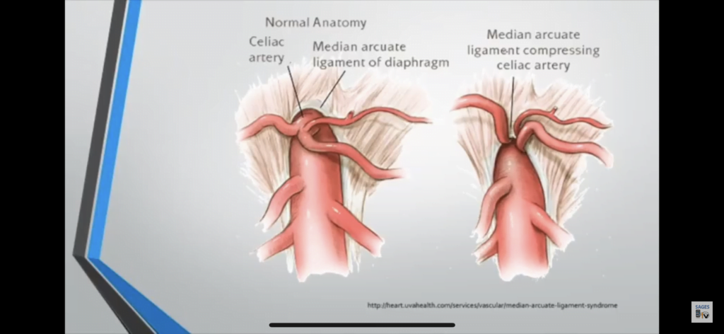 Understanding Median Arcuate Ligament Compression Syndrome: Rare but ...