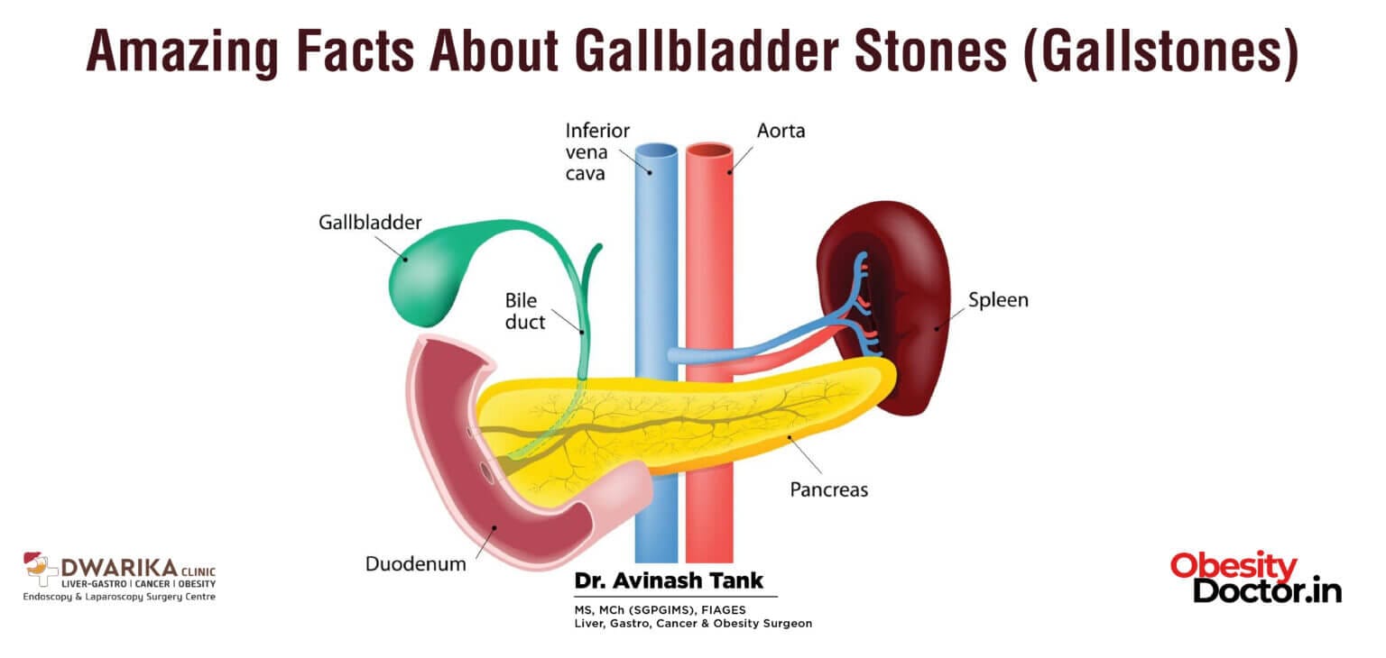 Amazing Facts About Gallbladder Stones (Gallstones) Dr AvinashTank