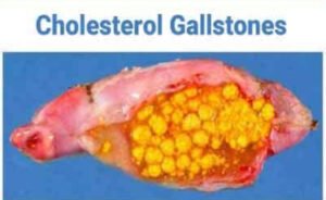Cholesterol Gallbladder stones