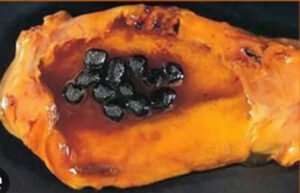 Pigmented Gallbladder stone