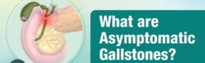Asymptomatic Gallbladder Stone Treatment