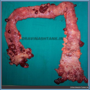 Colon Polyposis